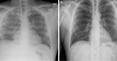 radiography and malaria treatment