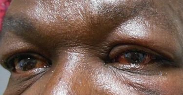 Common Eye Conditions in Nigeria and How to Treat Them