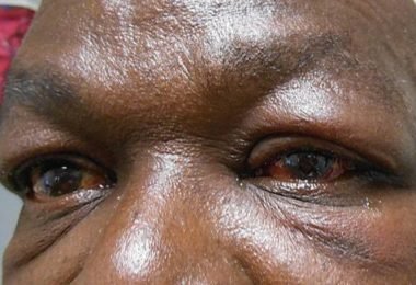 Common Eye Conditions in Nigeria and How to Treat Them